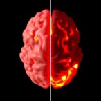 parkinson’s-outcomes-compared:-with-vs.-without-deep-brain-stimulation