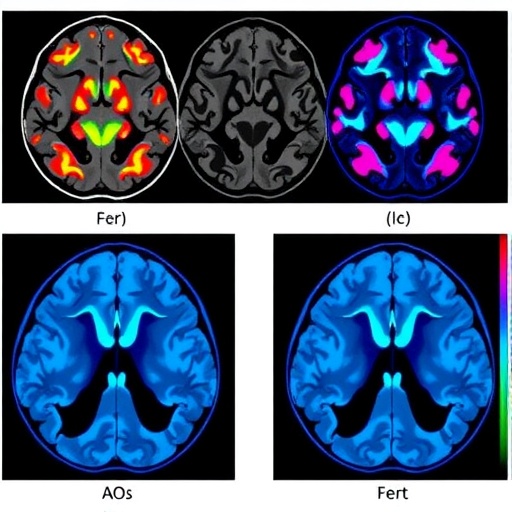 new-imidazotetrazine-drugs-defeat-glioblastoma-resistance