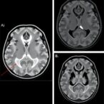 forensic-age-estimation-via-elbow-mri-in-chinese