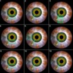 exploring-machine-learning-in-strabismus-surgery-predictions