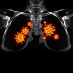 enhancing-kawasaki-disease-imaging-with-gold-nanoparticles