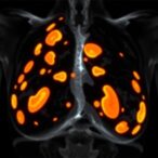 predicting-early-breast-cancer:-microcalcifications-and-risk-factors