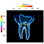 ai-predicts-tooth-extraction-with-limited-imaging-data