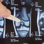 targeted-mrna-therapy-for-osteoarthritis-using-disease‑responsive-nanoparticles