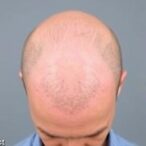 ai-and-machine-learning-transform-baldness-detection-and-management