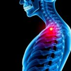 sarcopenia-elevates-risk-of-multiple-vertebral-fractures