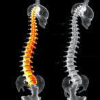 3d-printing-enhances-ultrasound-guidance-for-scoliosis-punctures