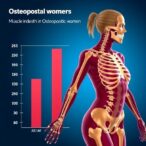 muscle-index-links-to-bone-health-in-osteoporotic-women