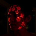 melasma’s-psychological-effects-on-asian-americans-and-anxious-individuals