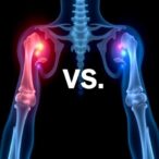 orexin-vs.-melatonin:-comparing-fracture-risk