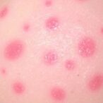 unexpected-rituximab-reactions-in-pemphigus-patients