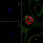 grem1-boosts-colorectal-cancer-spread-via-acvr1c