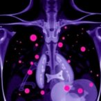 spark-trial:-new-treatment-for-triple-negative-breast-cancer