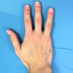 exploring-drug-induced-palmoplantar-pustulosis:-a-review