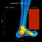 fremml:-new-tool-for-predicting-fracture-risk