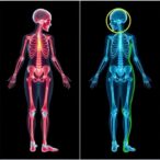 assessing-osteoporotic-fracture-risk-in-armenian-women