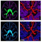 gpnmb+-macrophages-promote-vascular-fibrosis-in-glioblastoma
