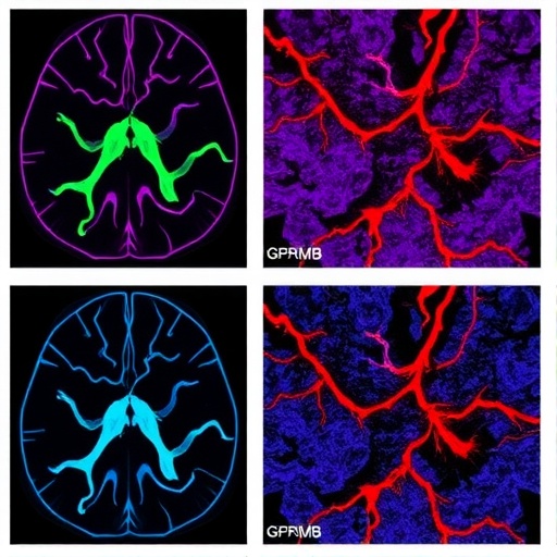 gpnmb+-macrophages-promote-vascular-fibrosis-in-glioblastoma