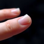 combatting-antifungal-resistance-in-candida-onychomycosis