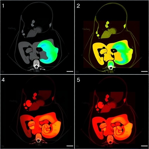imaging-megacystis-microcolon-syndrome-across-neonatal-stages