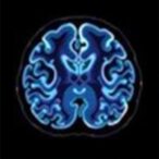 federated-learning-enhances-alzheimer’s-imaging-assessment