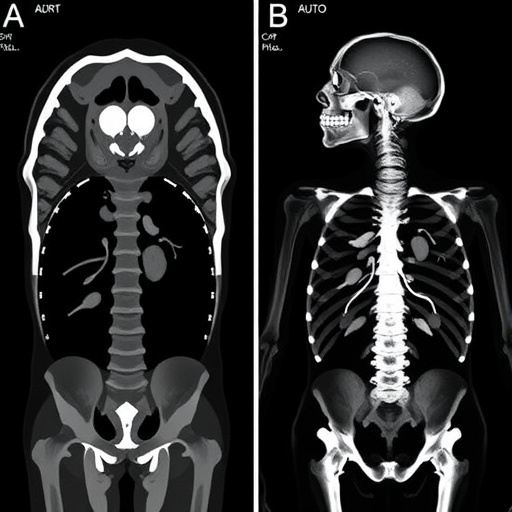 postmortem-ct-vs.-autopsy:-fracture-detection-compared