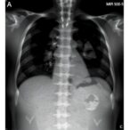 mir-503-5p:-a-biomarker-for-dvt-in-multiple-myeloma