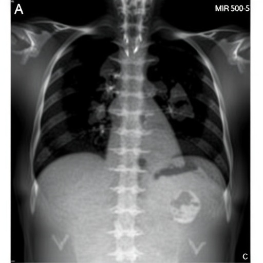 mir-503-5p:-a-biomarker-for-dvt-in-multiple-myeloma