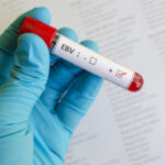twenty-two-genes-could-hike-risk-for-long-term-health-issues-after-epstein-barr-infection