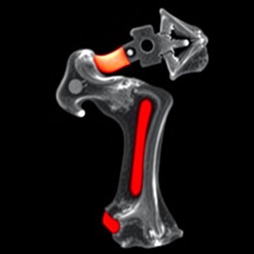 uncommon-imaging-features-of-chronic-nonbacterial-osteitis