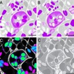 fam83h-as1:-new-noninvasive-ovarian-cancer-biomarker