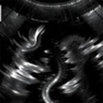 renal-doppler’s-impact-on-pediatric-nephrotic-syndrome