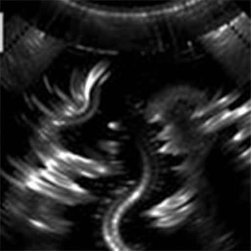 renal-doppler’s-impact-on-pediatric-nephrotic-syndrome