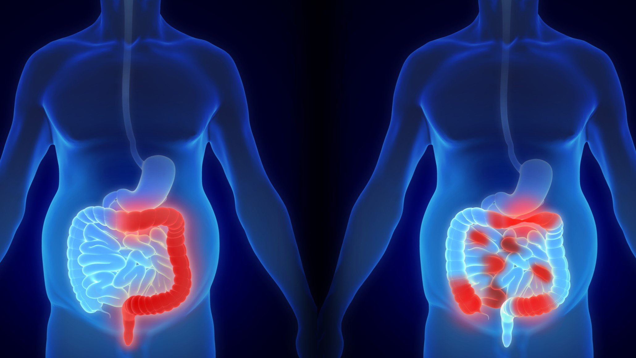 nhs-‘fit’-bowel-cancer-test-reduced-unnecessary-referrals-as-cancer-numbers-remain-stable