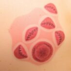 indolent-cutaneous-b-cell-lymphomas-mimic-persistent-antigen-reactions