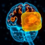 mussel-inspired-bioadhesive-patch-targets-and-eliminates-cells-in-aggressive-brain-tumors