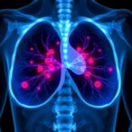 afuresertib-and-fulvestrant-trial-for-advanced-breast-cancer