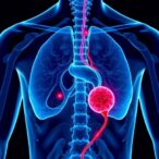 groundbreaking-jnccn-study-reveals-new-approaches-for-treating-recurring-prostate-cancer