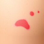 lactate-from-macrophages-fuels-skin-scarring