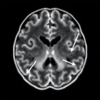 transcranial-doppler-predicts-future-moyamoya-stroke-risk