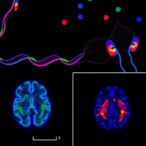 targeting-microglia-to-halt-multiple-sclerosis-progression