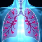 t-cell-traits-forecast-lung-cancer-immunotherapy-success