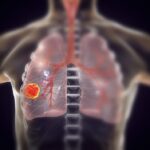 cancer-immunotherapy-improved-using-targeted-stress-protein