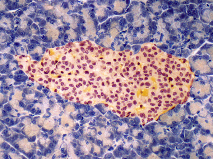 ai-maps-subtle-human-pancreatic-tissue-changes-linked-to-type-2-diabetes