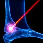 breakthrough-achievement:-laser-penetrates-bone-to-unprecedented-depths