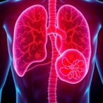 new-study-reveals-promising-immunotherapy-approach-for-early-stage-prostate-cancer