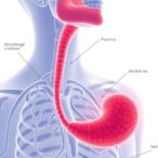 new-combo-therapies-tested-for-advanced-gastroesophageal-cancer