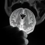clarifying-terms-in-neonatal-encephalopathy-trials