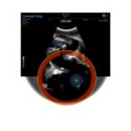fda-grants-de-novo-clearance-to-ultrasound-ai-for-delivery-date-prediction-technology