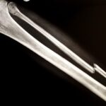 ai-musculoskeletal-imaging-medtechs-medimaps-and-radiobotics-pen-merger-deal
